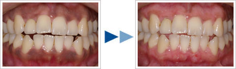 ガムピーリング治療例